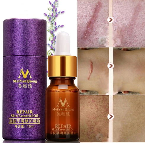 Scar Skin Repair Essential Oil Lavender Care Natural Skin Pure Remove Ance Burn Strentch Marks Removal Scar 10 ML - CHRISTDEST GLOBAL SERVICE